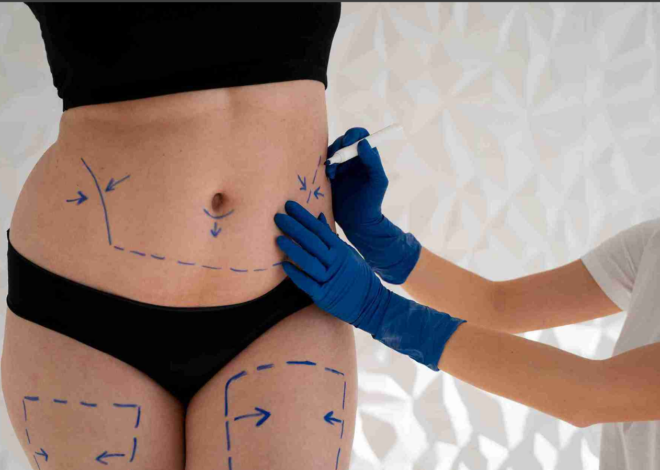 Sculpting Confidence: Liposuction Surgery in Delhi