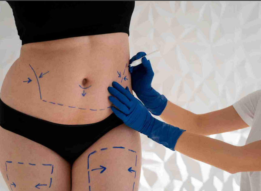 Sculpting Confidence: Liposuction Surgery in Delhi