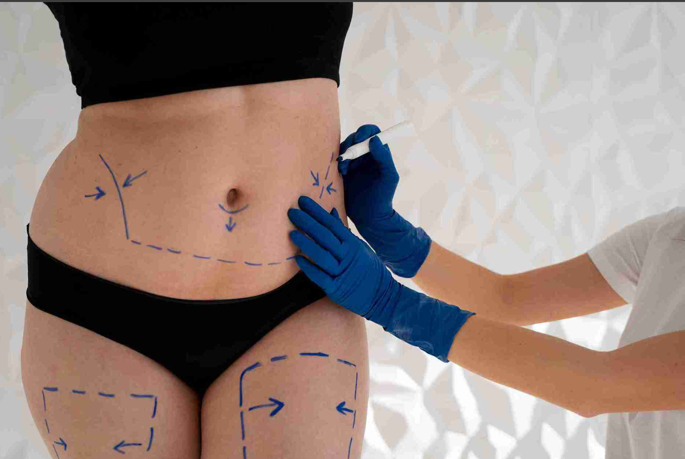 Sculpting Confidence: Liposuction Surgery in Delhi